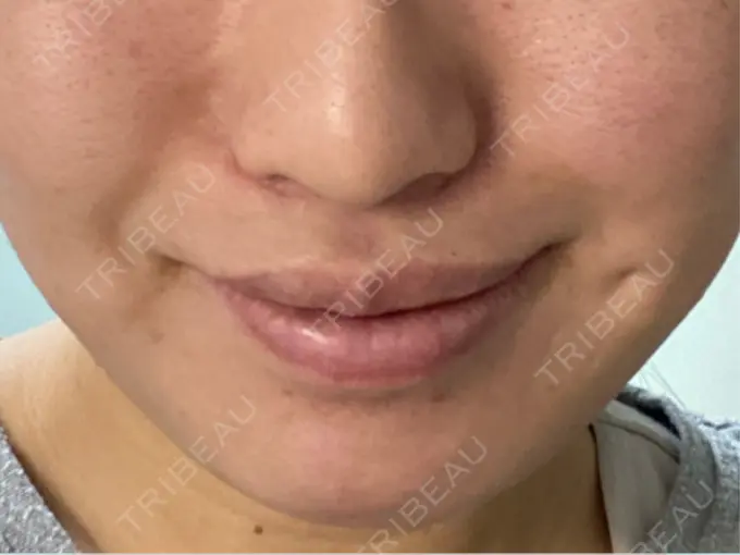 人中短縮 / 口唇縮小術 / 口角挙上 新宿ラクル美容外科クリニック 新宿院 DAY 125 メイン用