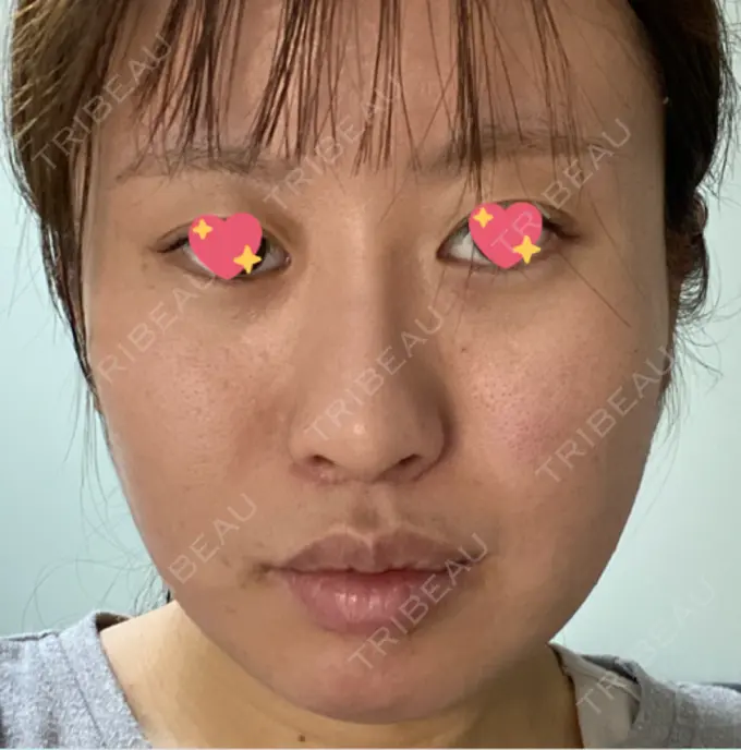 ほくろ・いぼ切除（肌） TCB東京中央美容外科 新潟院 AFTER メイン用