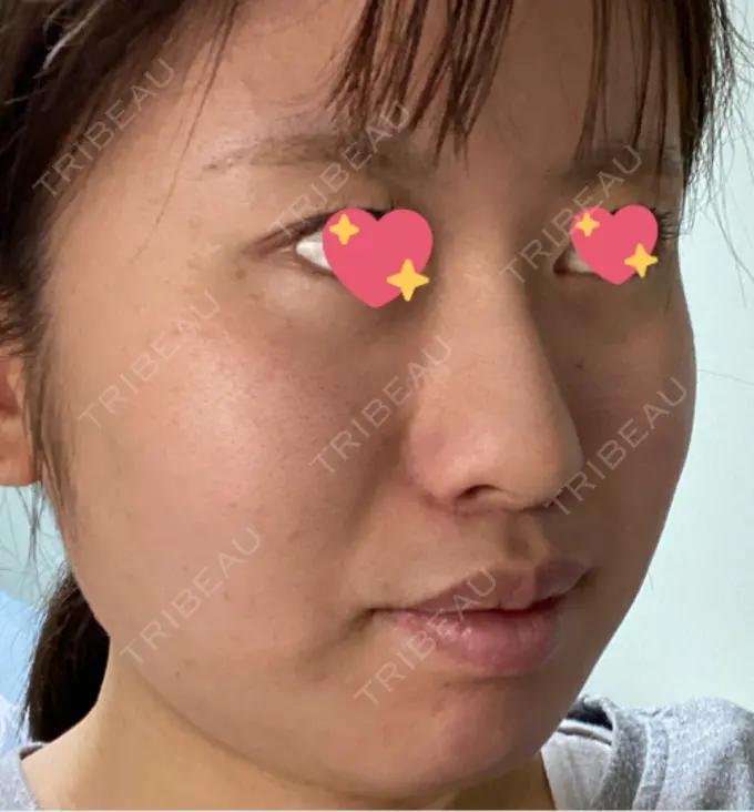 ほくろ・いぼ切除（肌） TCB東京中央美容外科 新潟院 DAY 81 メイン用