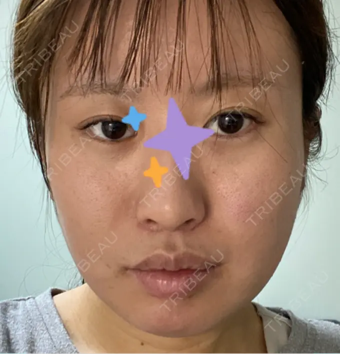 眼瞼下垂（非切開） / ピアス穴あけ / ニキビ治療 しむら皮膚科クリニック AFTER メイン用