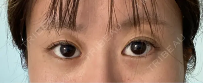 眼瞼下垂（非切開） / ピアス穴あけ / ニキビ治療 しむら皮膚科クリニック DAY 54 メイン用