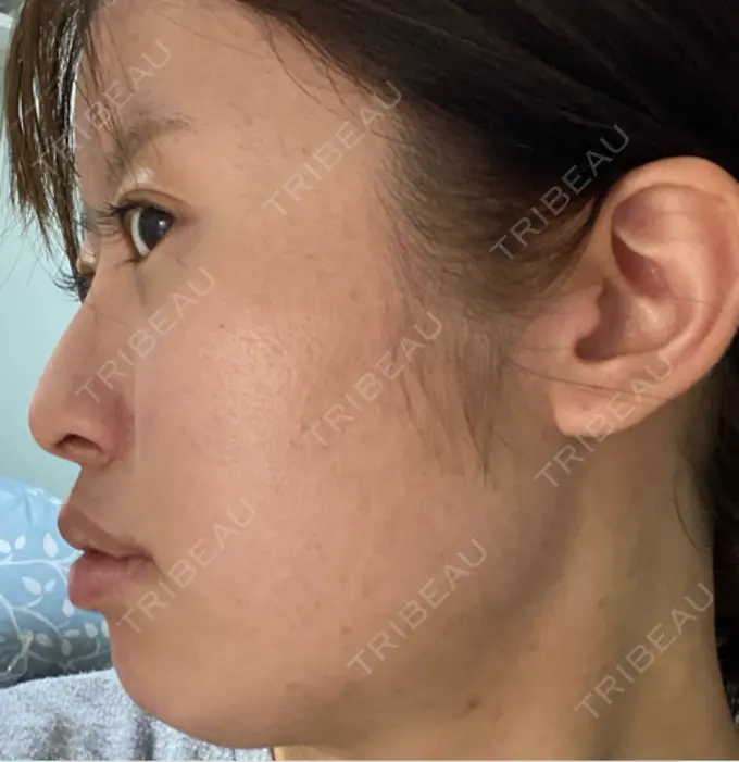 眼瞼下垂（非切開） / ピアス穴あけ / ニキビ治療 しむら皮膚科クリニック DAY 54 メイン用