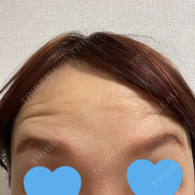 ボトックス（眉間） / ボトックス（額） TCB東京中央美容外科 北千住院 DAY 3 メイン用
