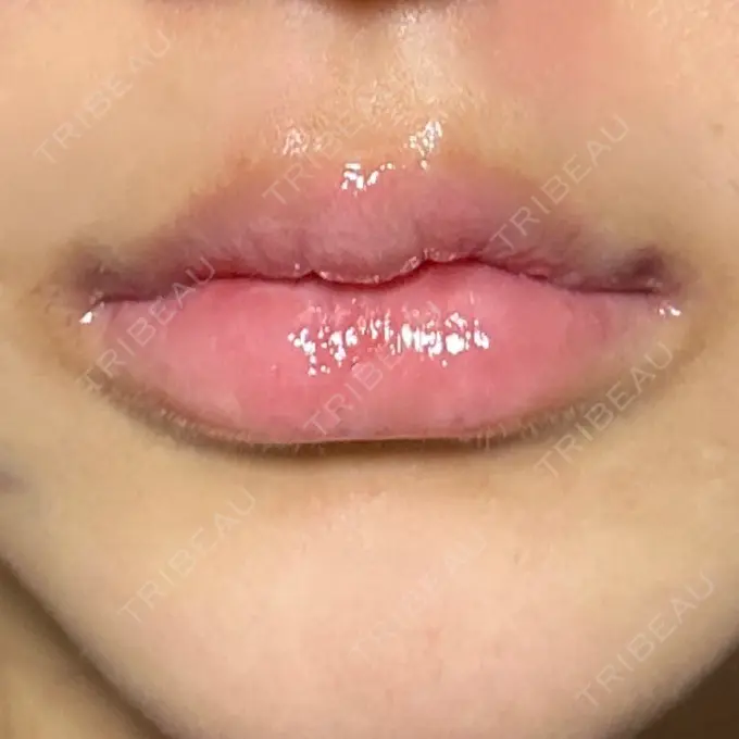 ヒアルロン酸注入（唇） / ボトックス（口角） ルラ美容クリニック 高田馬場院 DAY 1 メイン用