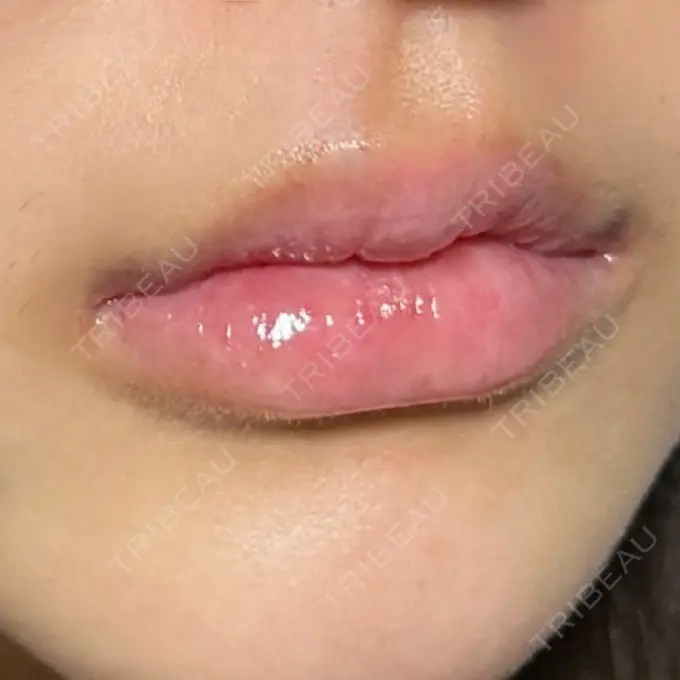 ヒアルロン酸注入（唇） / ボトックス（口角） ルラ美容クリニック 高田馬場院 DAY 1 メイン用