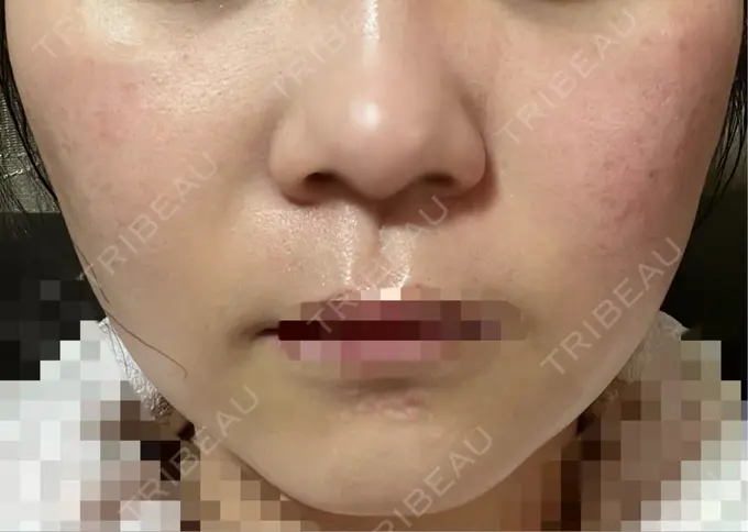 RF（高周波）たるみ治療 東京美容医療クリニック 池袋院 AFTER メイン用