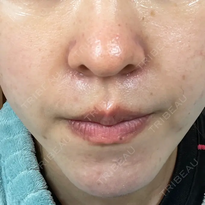 毛穴洗浄（ハイドラフェイシャルなど） 東京素肌クリニック 銀座本院 DAY 11 メイン用