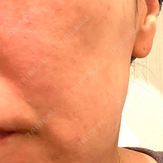 ボトックス（エラ・小顔） TCB東京中央美容外科 神戸院 DAY 14 メイン用