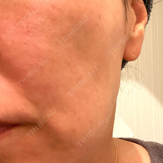 ボトックス（エラ・小顔） TCB東京中央美容外科 神戸院 DAY 14 メイン用