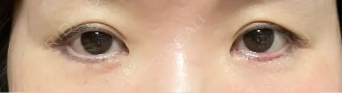 ヒアルロン酸注入（涙袋） 新未来クリニック DAY 14 メイン用