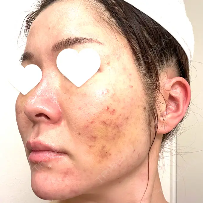 サブシジョン 藤・ナチュレ美容クリニック 銀座院 DAY 4 メイン用