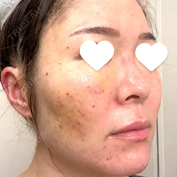 サブシジョン 藤・ナチュレ美容クリニック 銀座院 DAY 4 メイン用