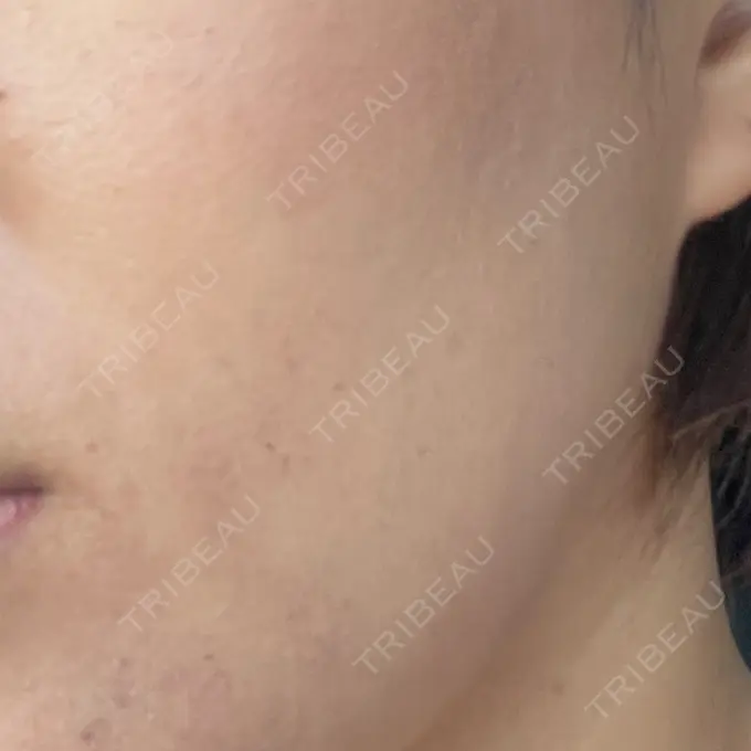 ルメッカ ルラ美容クリニック 静岡院 AFTER メイン用