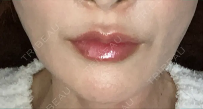 糸リフト / ヒアルロン酸注入（鼻翼基部） / リジュラン Brandnew Beauty Clinic AFTER メイン用