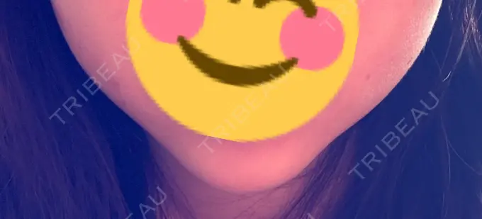 糸リフト / バッカルファット除去 / その他（輪郭） MEMOTO CLINIC 名古屋 DAY 12 メイン用