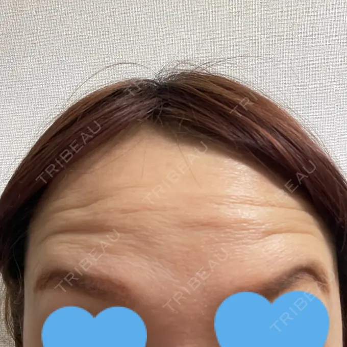 ボトックス（眉間） / ボトックス（額） TCB東京中央美容外科 北千住院 DAY 4 メイン用