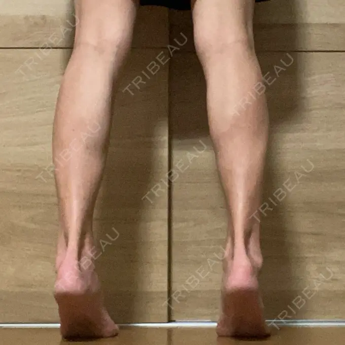 ボトックス（ふくらはぎ） TCB東京中央美容外科 神戸院 AFTER メイン用