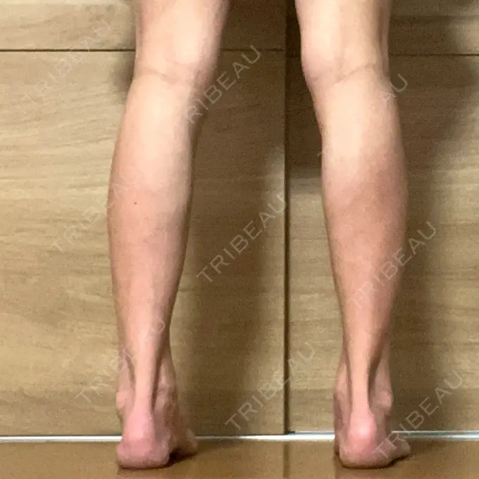 ボトックス（ふくらはぎ） TCB東京中央美容外科 神戸院 DAY 22 メイン用