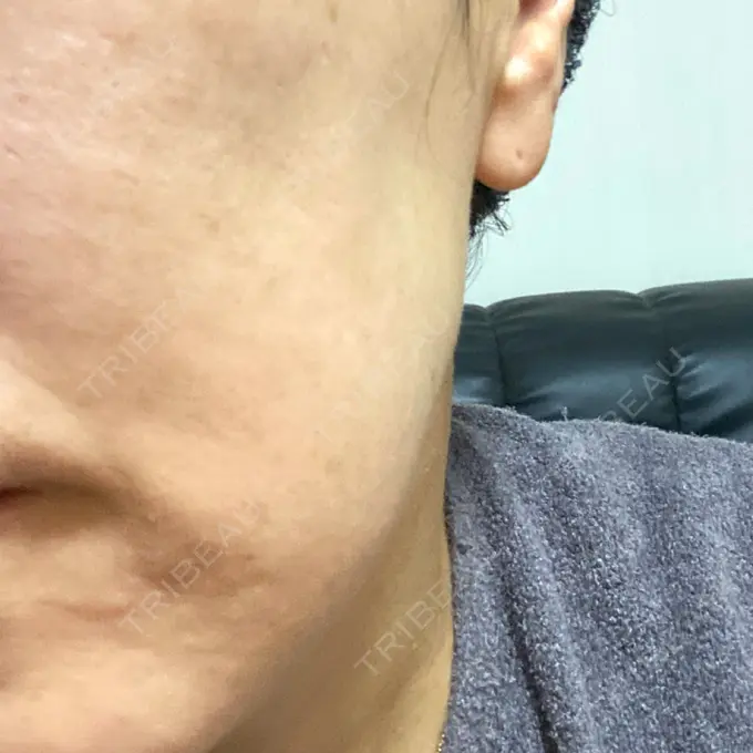 ボトックス（エラ・小顔） TCB東京中央美容外科 神戸院 DAY 15 メイン用