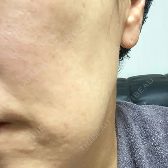 ボトックス（エラ・小顔） TCB東京中央美容外科 神戸院 DAY 15 メイン用