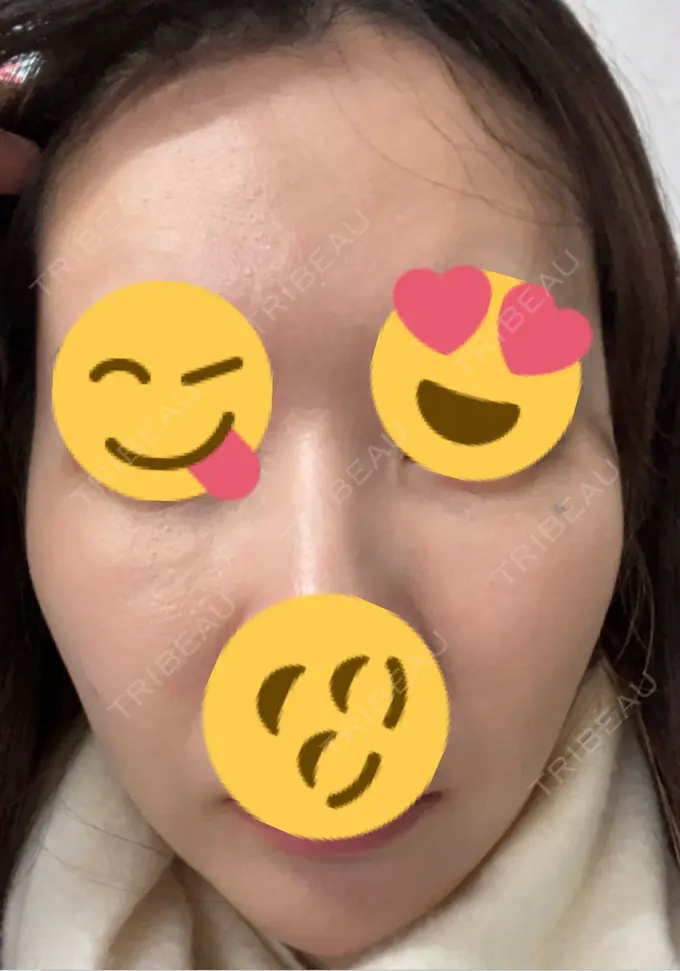 ピーリング（ニキビ・毛穴） / ヴェルヴェットスキン / ピーリング（ハリ・ツヤ） ミニマムスキンクリニック池袋 DAY 3 メイン用