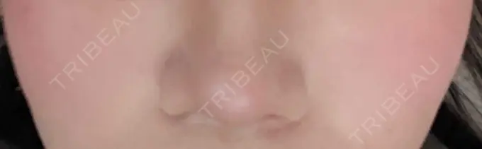 ピーリング（ニキビ・毛穴） / イオン導入 / 光治療（フォトフェイシャルなど） 東京素肌クリニック 銀座本院 AFTER メイン用