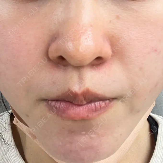 毛穴洗浄（ハイドラフェイシャルなど） 東京素肌クリニック 銀座本院 AFTER メイン用