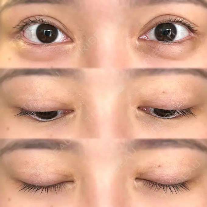 二重切開 / 目頭切開 / クマ治療 / 目尻切開 / 上まぶたたるみ取り / 下まぶたの脂肪取り / 脂肪注入（目の下） 湘南美容クリニック 大阪堺東院 AFTER メイン用