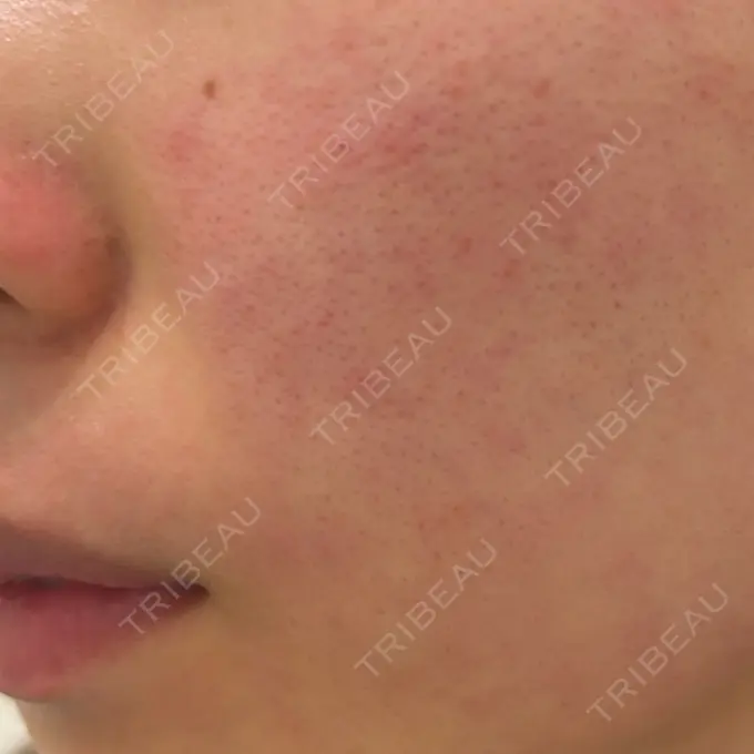 イオン導入 / ピコレーザートーニング（美白・肝斑） / フラクショナルレーザー（毛穴・ニキビ跡） ルラ美容クリニック 横浜院 DAY 0 メイン用