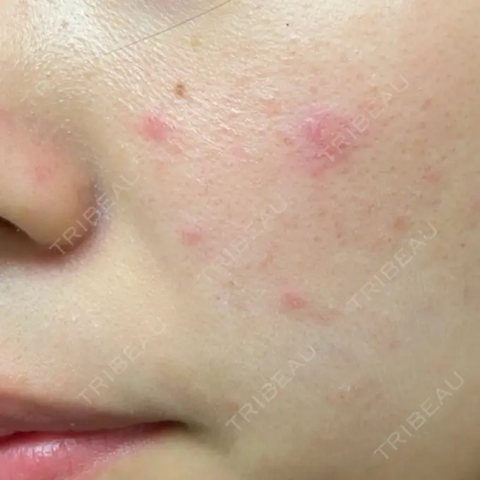 イオン導入 / ピコレーザートーニング（美白・肝斑） / フラクショナルレーザー（毛穴・ニキビ跡） ルラ美容クリニック 横浜院 DAY 1 メイン用