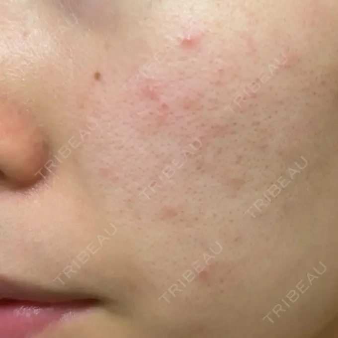 イオン導入 / ピコレーザートーニング（美白・肝斑） / フラクショナルレーザー（毛穴・ニキビ跡） ルラ美容クリニック 横浜院 DAY 2 メイン用