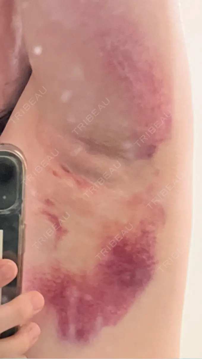 ワキ汗治療（レーザー） Fellez Clinic【フェルズクリニック】 DAY 4 メイン用