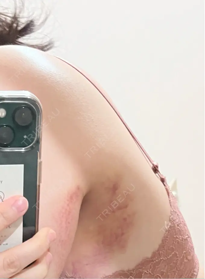 ワキ汗治療（レーザー） Fellez Clinic【フェルズクリニック】 DAY 5 メイン用