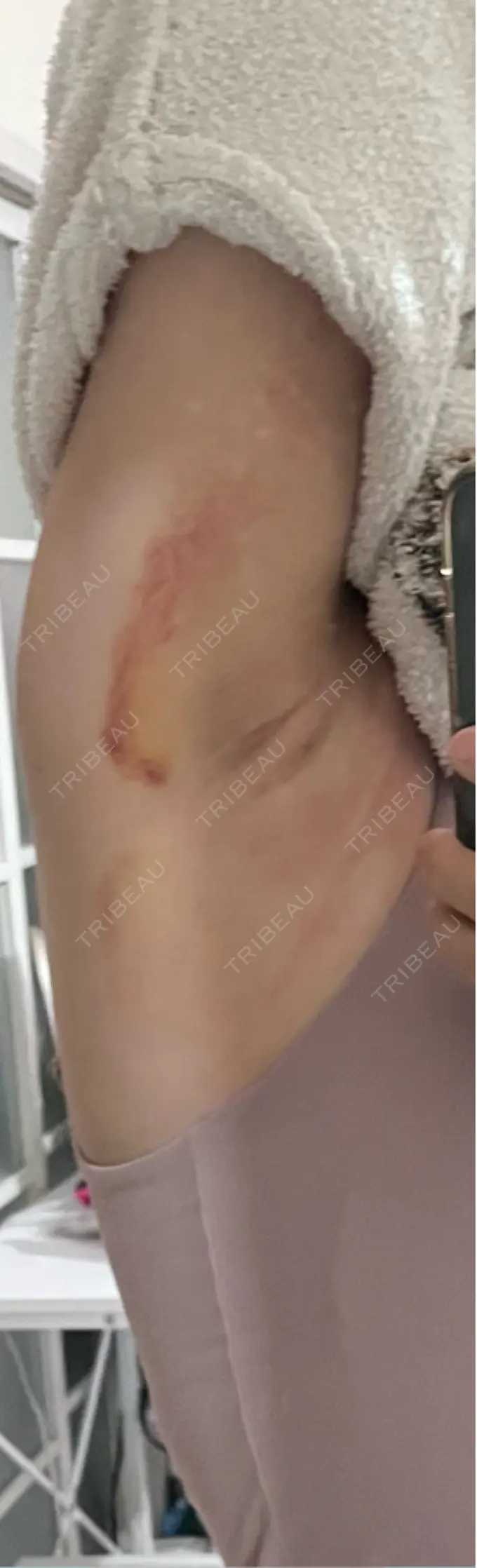 ワキ汗治療（レーザー） Fellez Clinic【フェルズクリニック】 DAY 6 メイン用