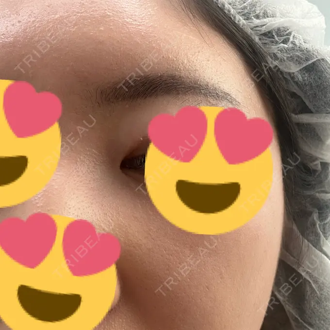 糸リフト / 脂肪吸引（顔） / 脂肪吸引（二の腕） / 上まぶたたるみ取り / 上まぶたの脂肪取り / ジョールファット除去 / 脂肪吸引（肩） / ボトックス（エラ・小顔） 湘南美容クリニック 秋葉原院 DAY 203 メイン用