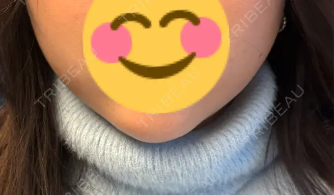 糸リフト / バッカルファット除去 / その他（輪郭） MEMOTO CLINIC 名古屋 AFTER メイン用