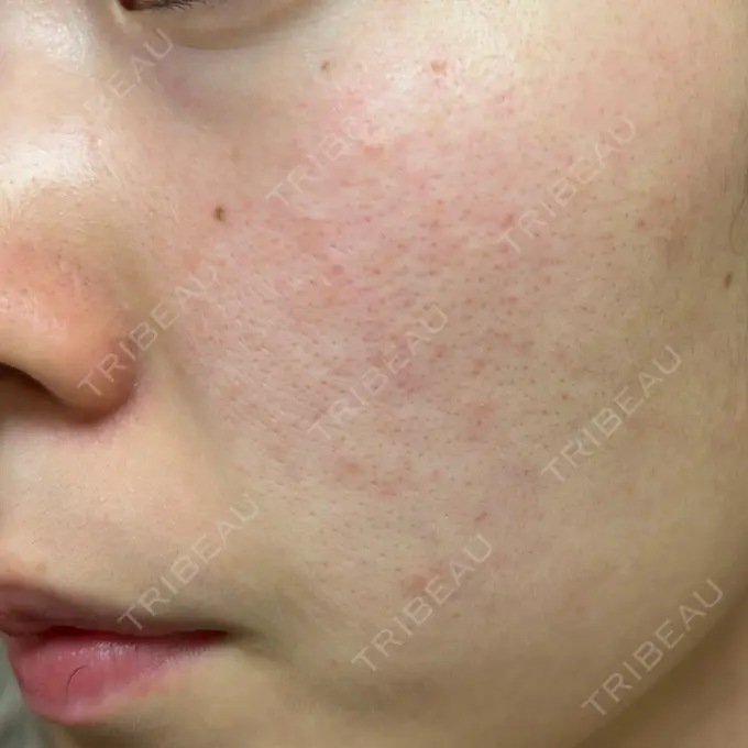 イオン導入 / ピコレーザートーニング（美白・肝斑） / フラクショナルレーザー（毛穴・ニキビ跡） ルラ美容クリニック 横浜院 DAY 3 メイン用