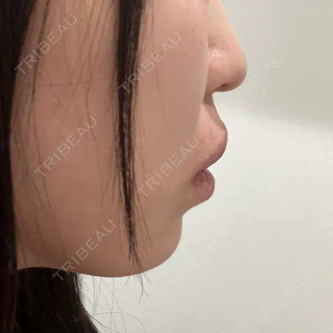 ヒアルロン酸注入（あご） / ヒアルロン酸注入（唇） / ボトックス（口角） ルラ美容クリニック 高田馬場院 DAY 0 メイン用