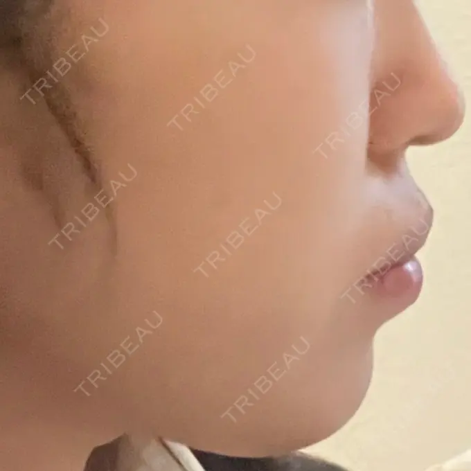 ヒアルロン酸注入（あご） / ヒアルロン酸注入（唇） / ボトックス（口角） ルラ美容クリニック 高田馬場院 DAY 1 メイン用