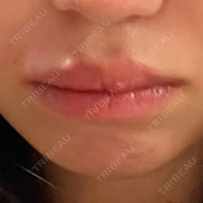 ヒアルロン酸注入（あご） / ヒアルロン酸注入（唇） / ボトックス（口角） ルラ美容クリニック 高田馬場院 DAY 0 メイン用