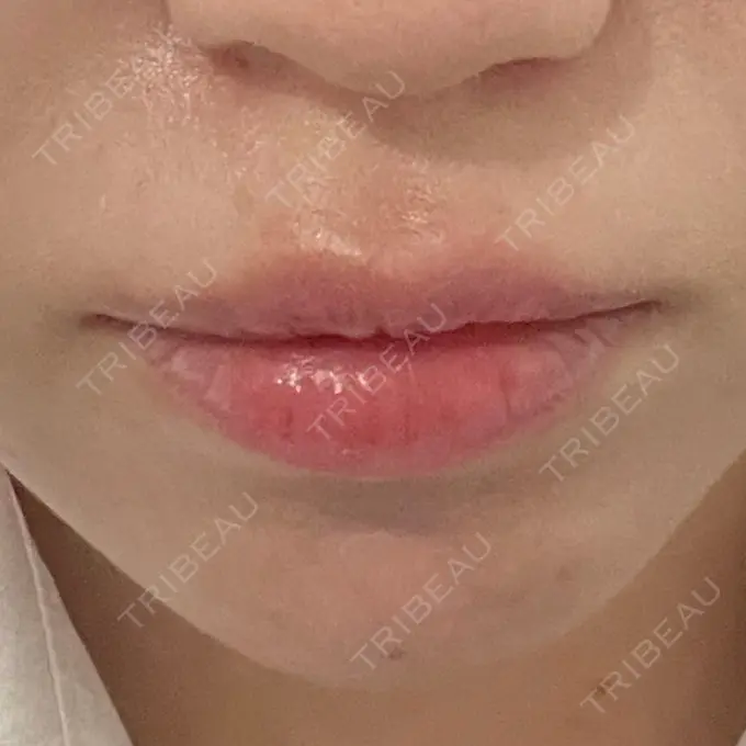 ヒアルロン酸注入（あご） / ヒアルロン酸注入（唇） / ボトックス（口角） ルラ美容クリニック 高田馬場院 DAY 1 メイン用