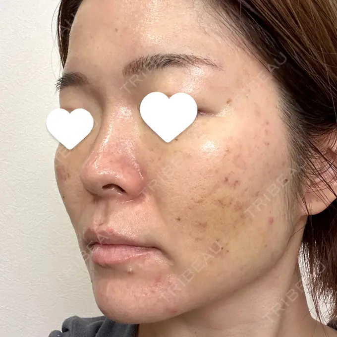 サブシジョン 藤・ナチュレ美容クリニック 銀座院 DAY 7 メイン用