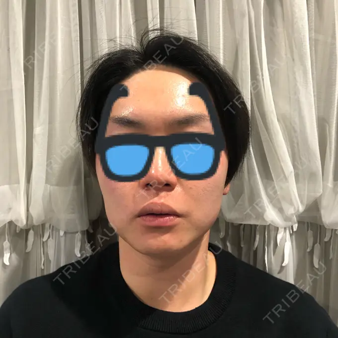 ボトックス（エラ・小顔） おおたかの森ビューティークリニック AFTER メイン用