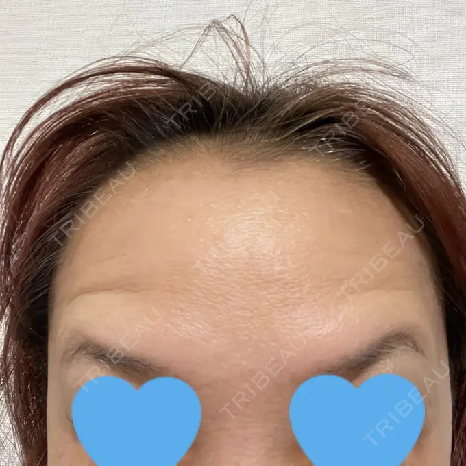 ボトックス（眉間） / ボトックス（額） TCB東京中央美容外科 北千住院 DAY 7 メイン用