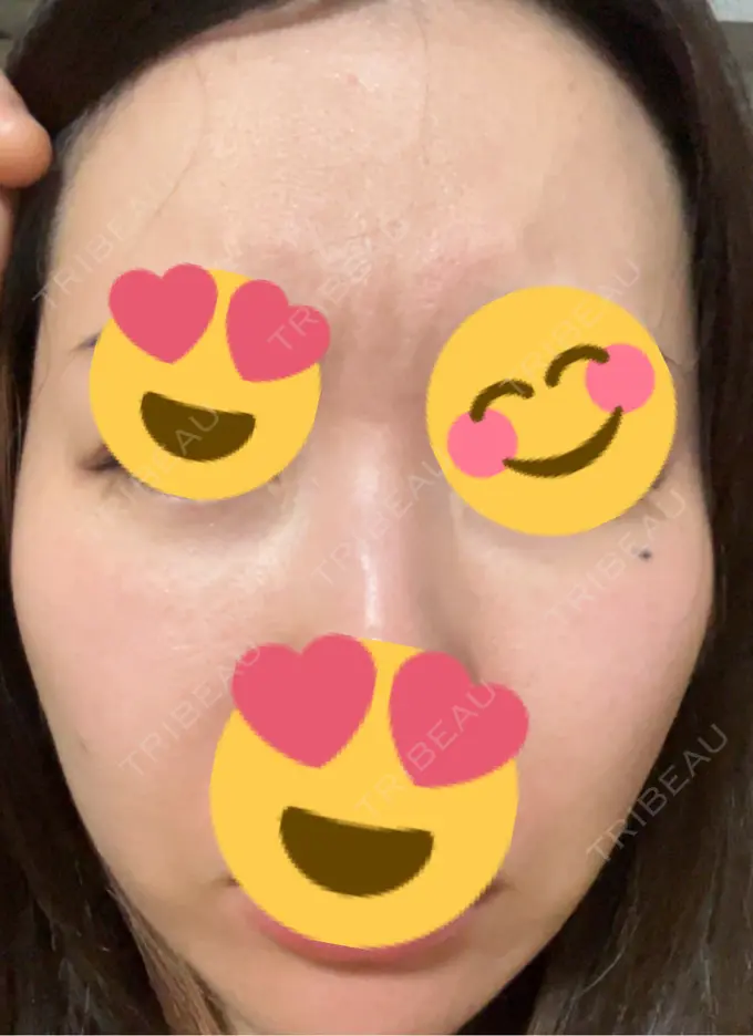 ピーリング（ニキビ・毛穴） / ヴェルヴェットスキン / ピーリング（ハリ・ツヤ） ミニマムスキンクリニック池袋 DAY 5 メイン用