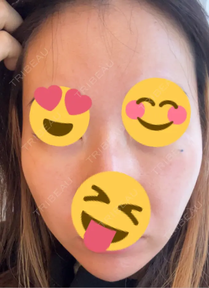 ピーリング（ニキビ・毛穴） / ヴェルヴェットスキン / ピーリング（ハリ・ツヤ） ミニマムスキンクリニック池袋 DAY 6 メイン用