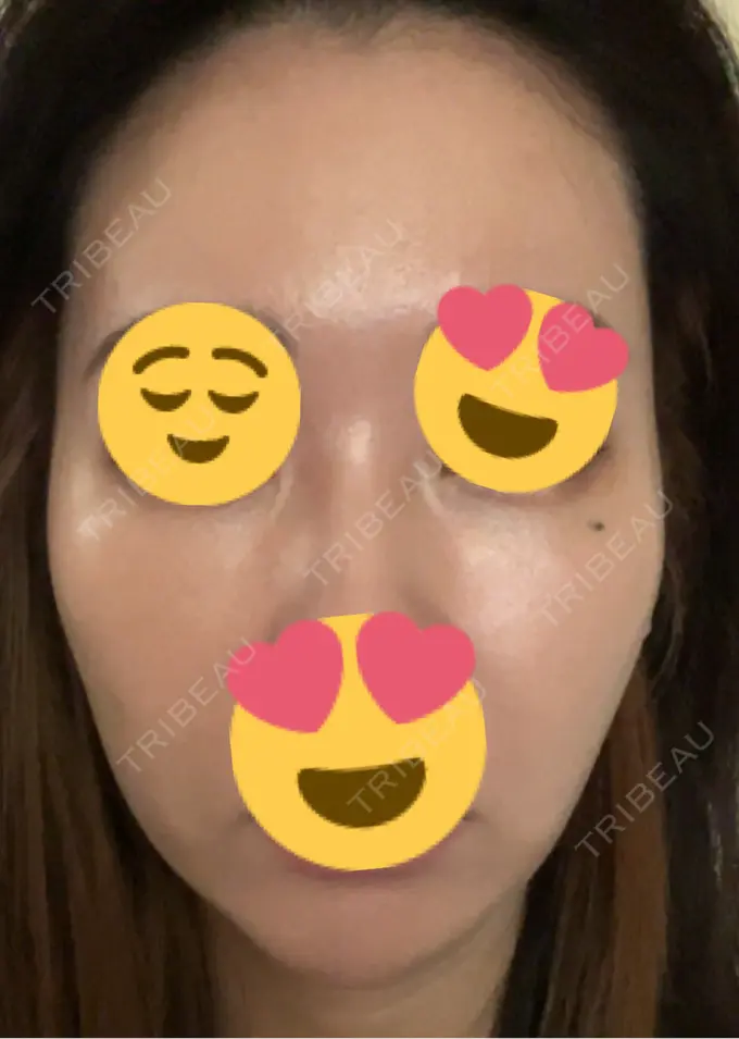 ピーリング（ニキビ・毛穴） / ヴェルヴェットスキン / ピーリング（ハリ・ツヤ） ミニマムスキンクリニック池袋 DAY 4 メイン用