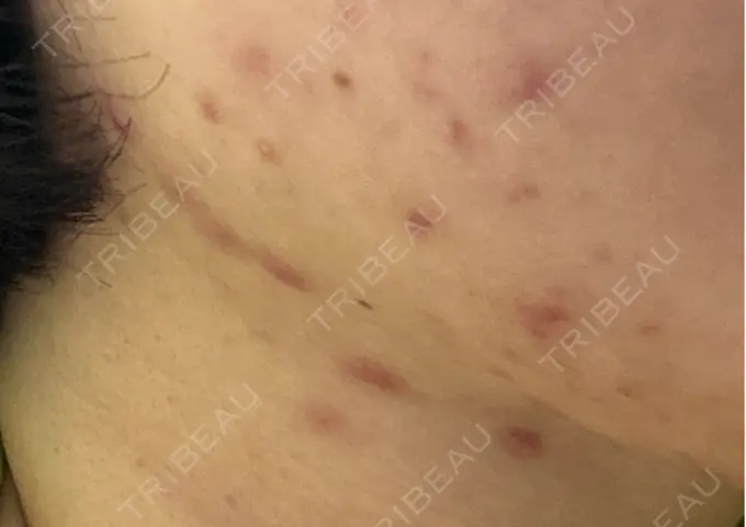 アグネス 日本美容・医療クリニック 六本木院 AFTER メイン用