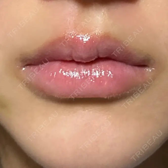 ヒアルロン酸注入（唇） / ボトックス（口角） ルラ美容クリニック 高田馬場院 DAY 7 メイン用