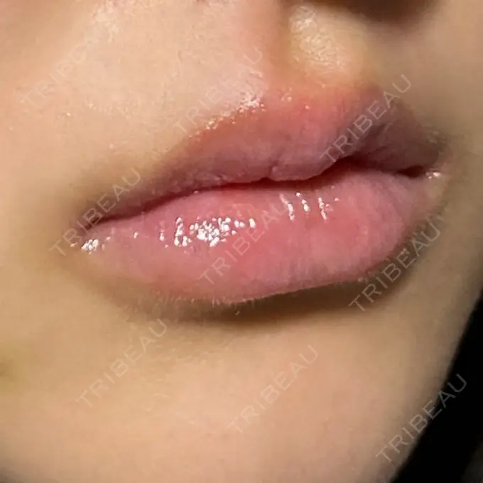 ヒアルロン酸注入（唇） / ボトックス（口角） ルラ美容クリニック 高田馬場院 DAY 7 メイン用